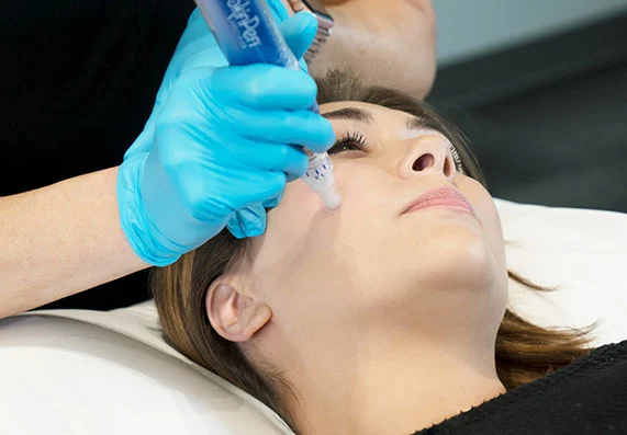 SkinPen Microneedling Procedure at Red Carpet Aesthetics